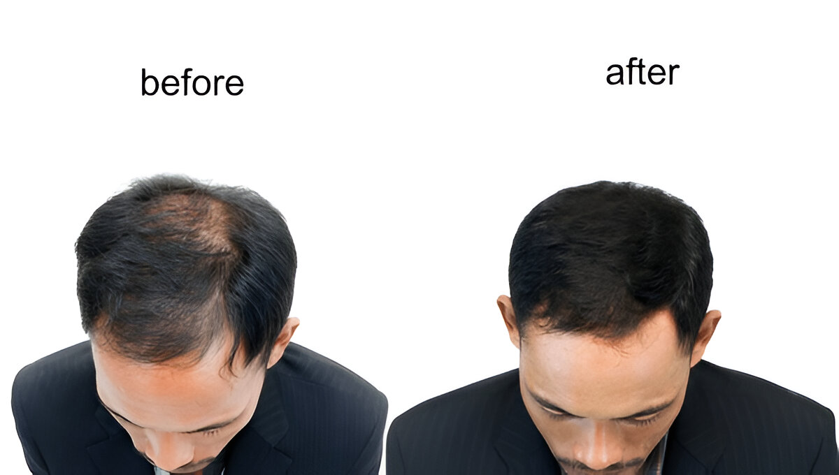 Before and After Hair Transplant